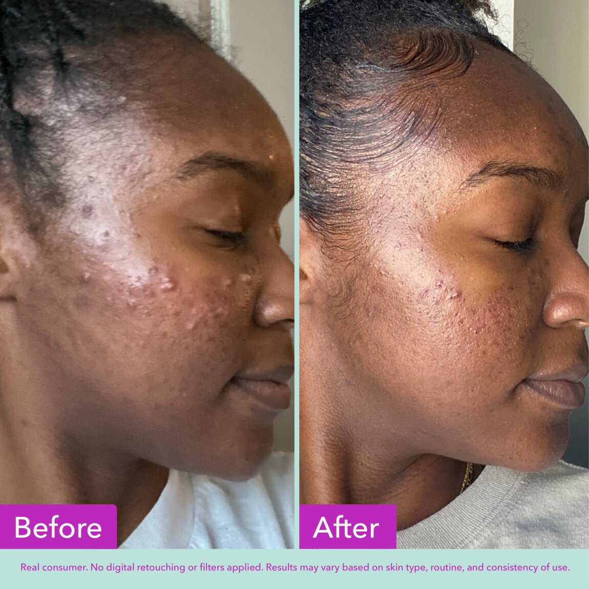 acne-foaming-cleanser-e0 zb_p.jpg