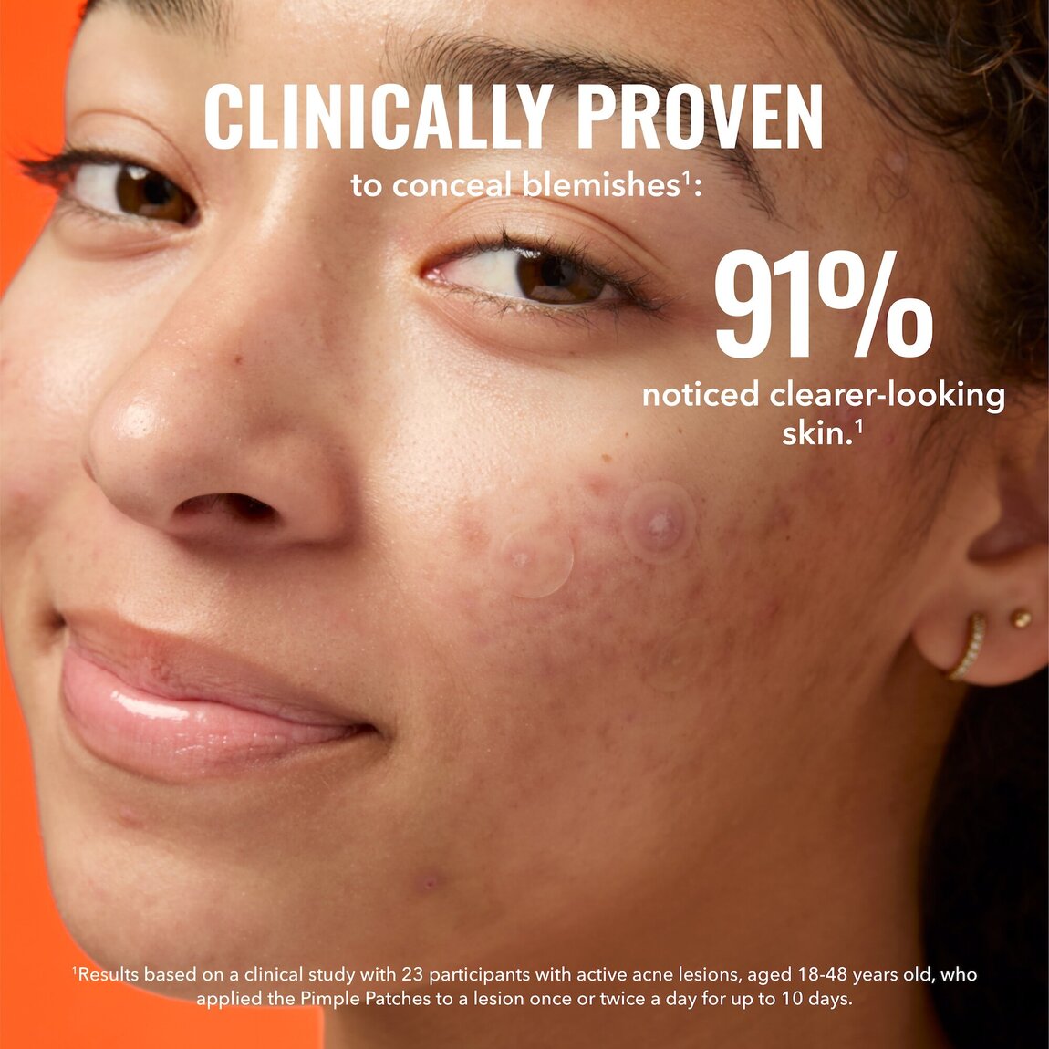pimple-patches-u3 zb_p.jpg